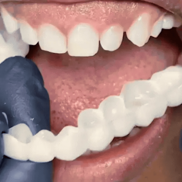 ¡Transforma tu sonrisa al instante con Sonrisa Instantánea!